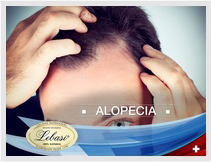 alopecia